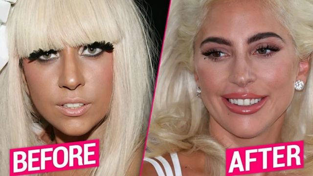 Lady Gaga Plastic Surgery