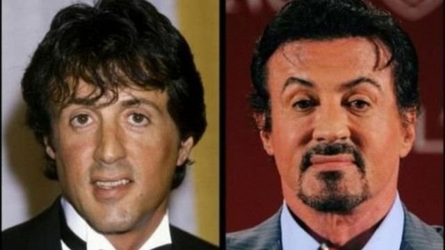 Sylvester Stallone Plastic Surgery