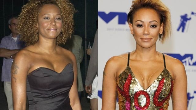 Mel B Plastic Surgery