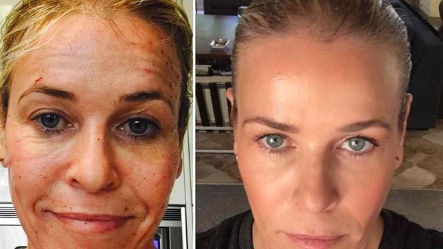 Chelsea Handler Plastic Surgery